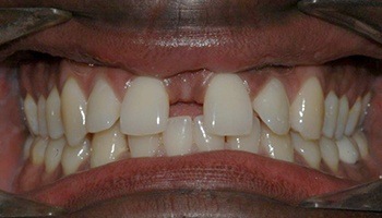 Closeup of teeth with large gap between front teeth
