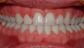 Closeup of aligned smile and closed gap between teeth