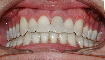 Closeup of aligned teeth and corrected bite