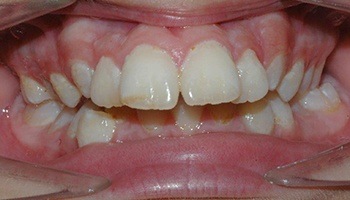 Closeup of crooked teeth and severe overbite