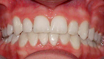 Closeup of smile with overbite correction