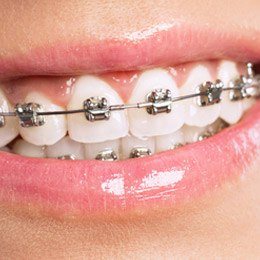 Smile with self litigating braces